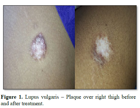 scitechcentral's tweet photo. #Title: Journal of #AllergyResearch
#Issue: A Mini-Review on the Current Trends of #CutaneousTuberculosis.
#Author: Rajkumar Kannan
https://t.co/hUIUog7O4Z
#Tuberculosis #BacillusCalmetteGuérin #Moxifloxacin #Pyrazinamide https://t.co/GLC3qGX52r