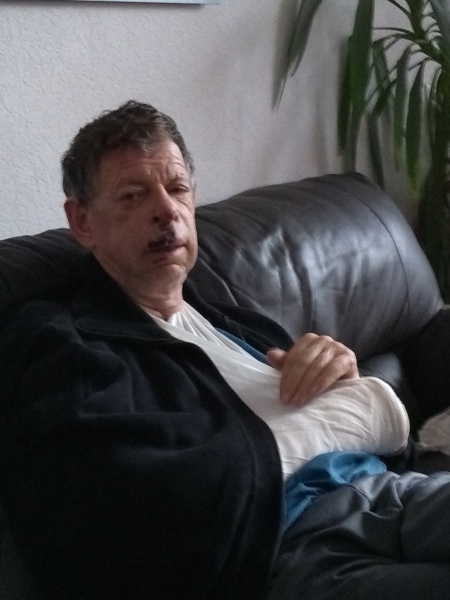hanneke195896's tweet photo. Mijn partner, mijn maatje, mijn mantelzorger zit zelf in de lappenmand.
Lelijk gevallen op straat.
Bovenlip gescheurd en gehecht.
Voortanden los.
Rechterarm in het gips.
#zorgenvoormijnmantelzorger
#whitlove
#loveofmylife
@mdekker55 https://t.co/SsvLrGuBbo