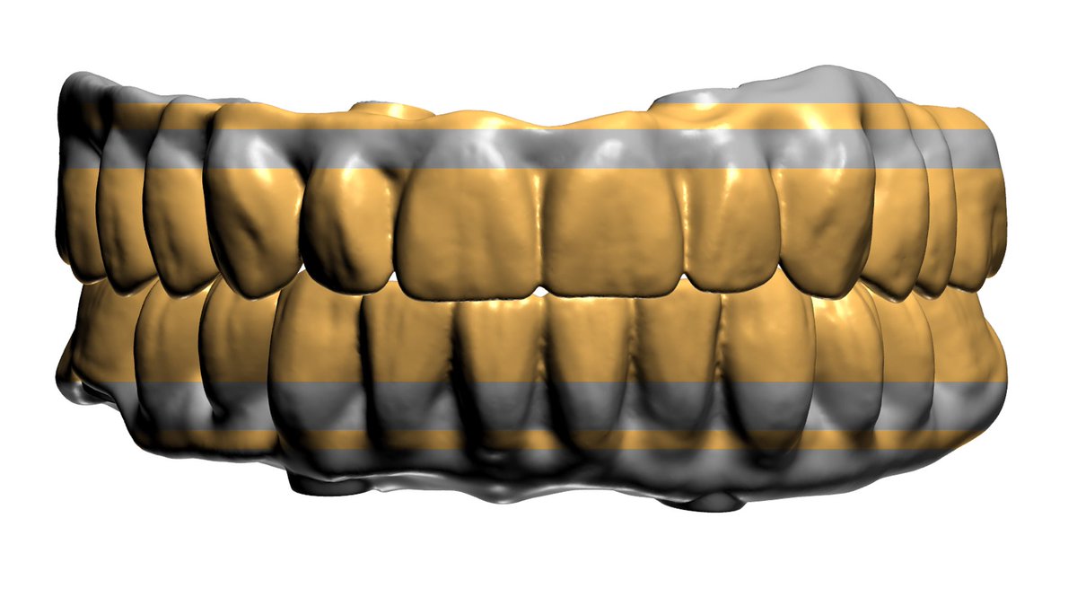 LorantStumpf's tweet photo. #digital, #dentistry, #cad, #cam, #digitaldentistry, #cadcam, #dentistry, #digital, #3shape, #dental, #intraoralscanning, #impressiontaking, #implants, #digitalsolution, #digitalrestoration, #dentallab, #printing, #education, #technology, #cadcamdentistry, #digitalimpression https://t.co/OuoPm6Kcwd