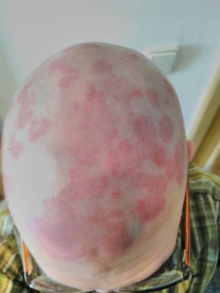 cannaworldsite's tweet photo. Psoriasis vs cannabis oil after 32 days. https://t.co/2nDsVvfngf