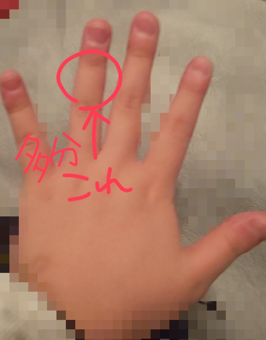 ゆきの 絵描きさんのペンだこが見たい 変な持ち方してるのですがこの前色々検証した結果指5本全て使って書いていますね T Co Wzztwzmiqa Twitter