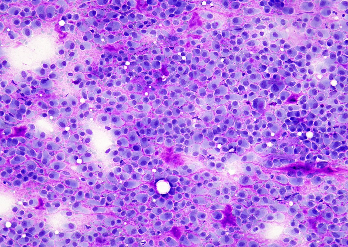 More "Turtles on the Beach" - Despite the presence of focal stromal matrix, this parotid FNA turned out to be a "Low-grade Myoepithelial Carcinoma". 
FNA called "Neoplasm-SUMP, with myoepithelial differentiation".