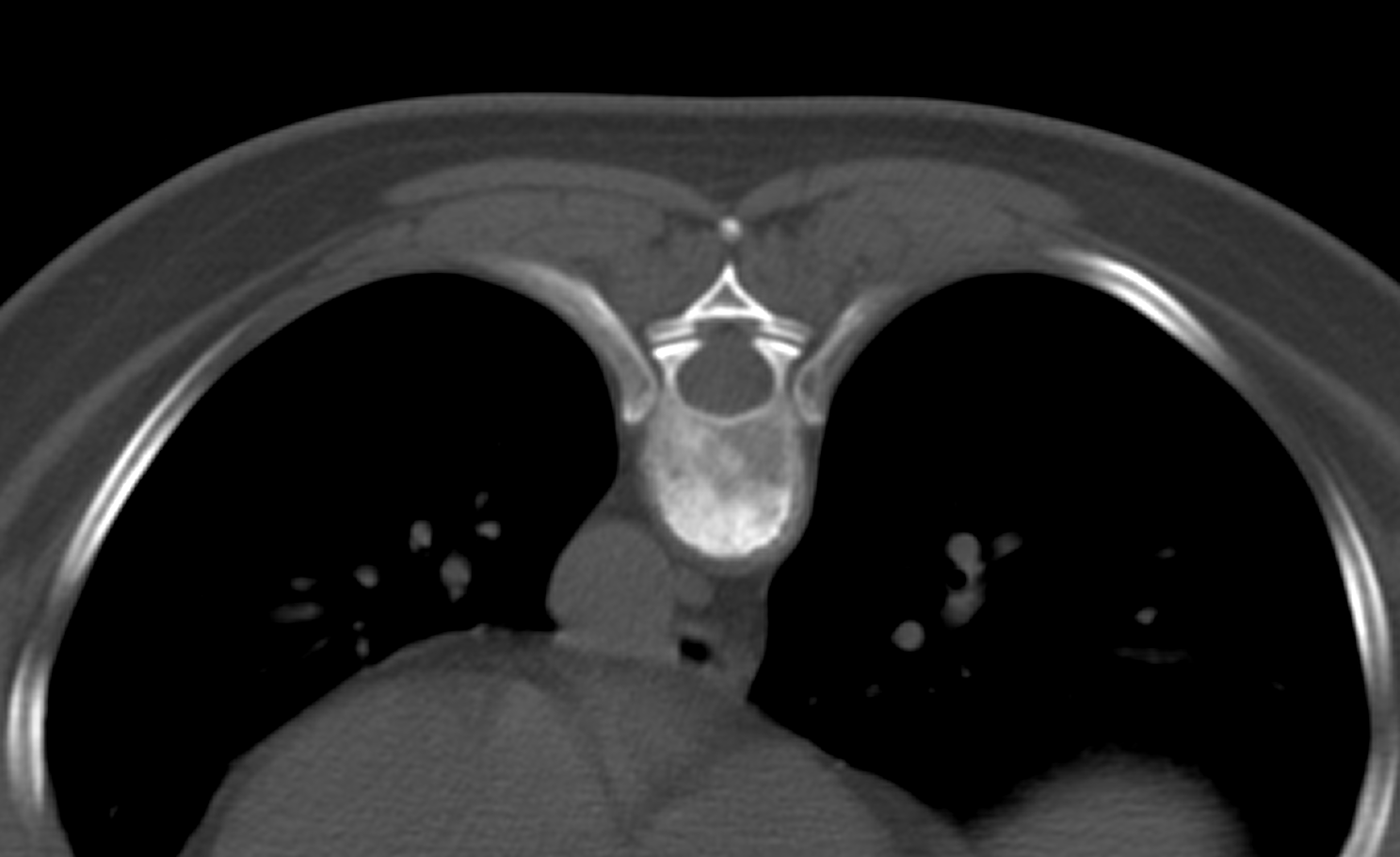 NSH Radiology On Twitter Possible Tuberculous Spondylodiscitis ID