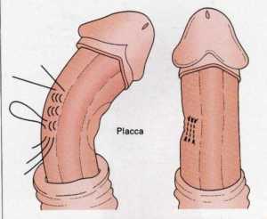 Irregular Improvement Of The Penis