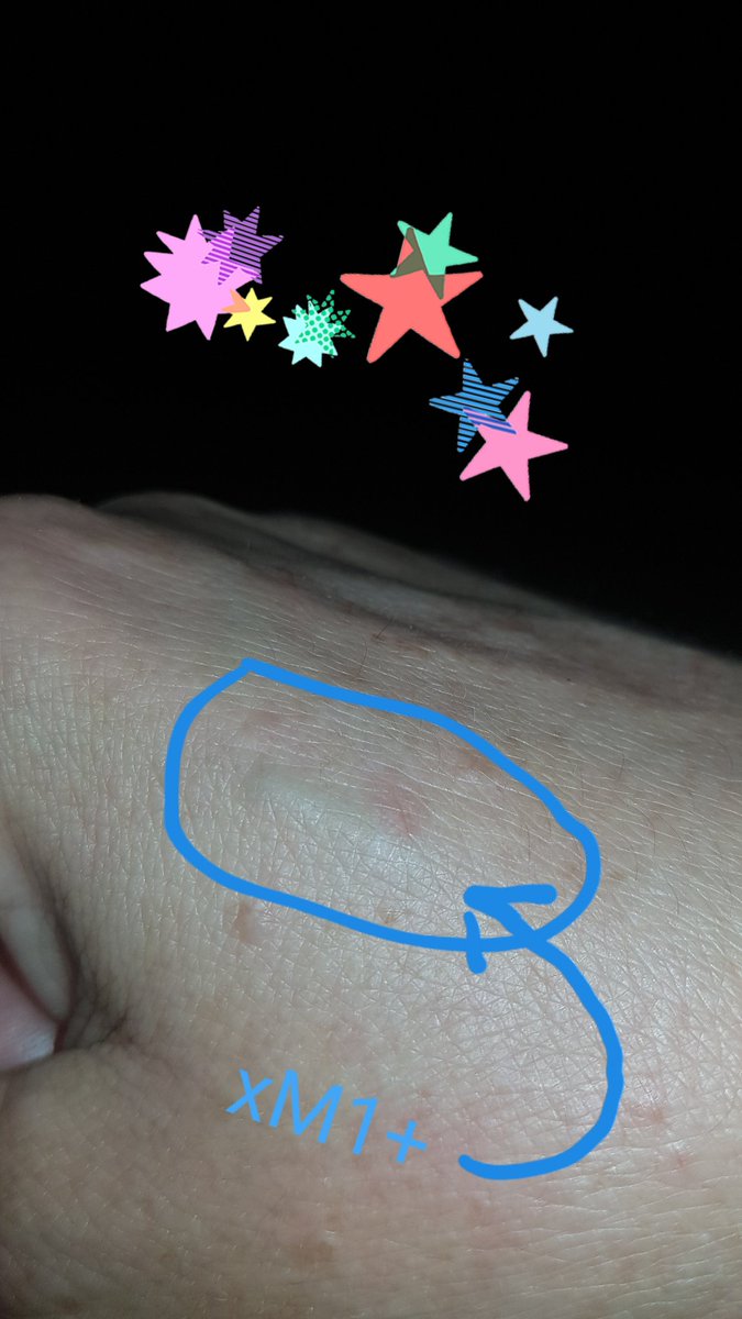 I love it, that the xM1+ is visible 😍
It was the best choice in my life to get chipped.

#rfid #nfc #rfidchip #nfcchip #chipimplantat #chipimplant #rfidimplantat #rfidimplant #nfcimplant #nfcimplantat #chipped #cyborg  #rfidimplantee #chipimplants 
#chipimplants #rfidchips