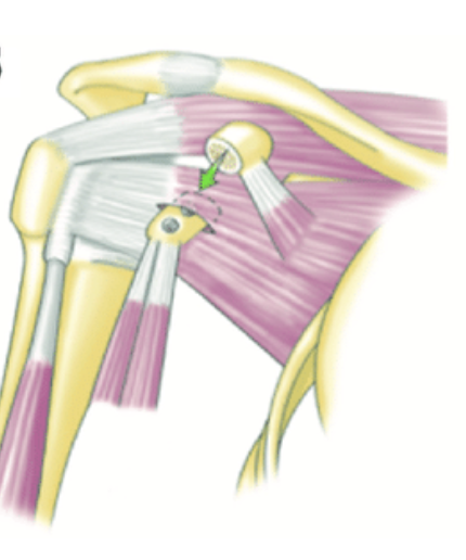 drprovencher's tweet image. When should a patient have a #LatarjetProcedure ? 

In certain patients, the damage after a dislocation may be so severe an arthroscopic approach may not correctly repair the injury. This may be because of bone loss during the dislocation, chronic instability, or...