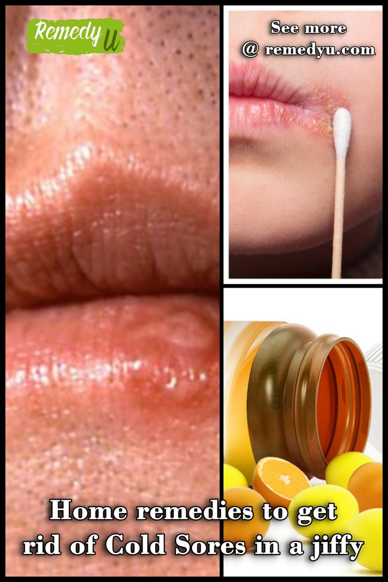 remedy_u's tweet photo. Home remedies to get rid of Cold Sores in jiffy
https://t.co/RAiUGMiS25
#Remedies #HomeRemedies #BestHomeRemedies #AmazingRemedies #EffectiveRemedies #RemediestoProduceHealth #Health #HealthBenefits #HealthTips #HealthBenifitAndTips #GetRidofColdSores #ColdSoresinajiffy #Remedyu https://t.co/sjeacJDltq
