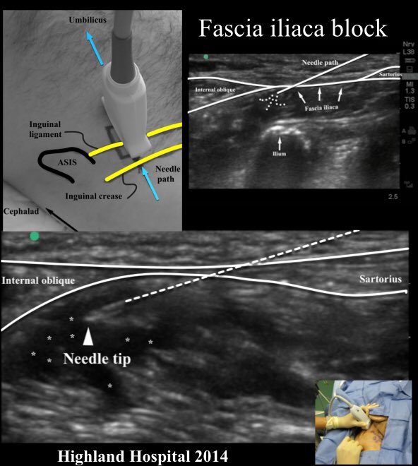 UlhtA's tweet photo. After our joint ACP and Middle grade teaching a few weeks ago .. 2 ACPs did their first hands on fascia iliac block today for fractured nof! Amazing to see the quick pain relief for the patient! @ULHT_News #ACP #improvingpatientcare #multiprofessionallearning https://t.co/J1EK0O3pJv