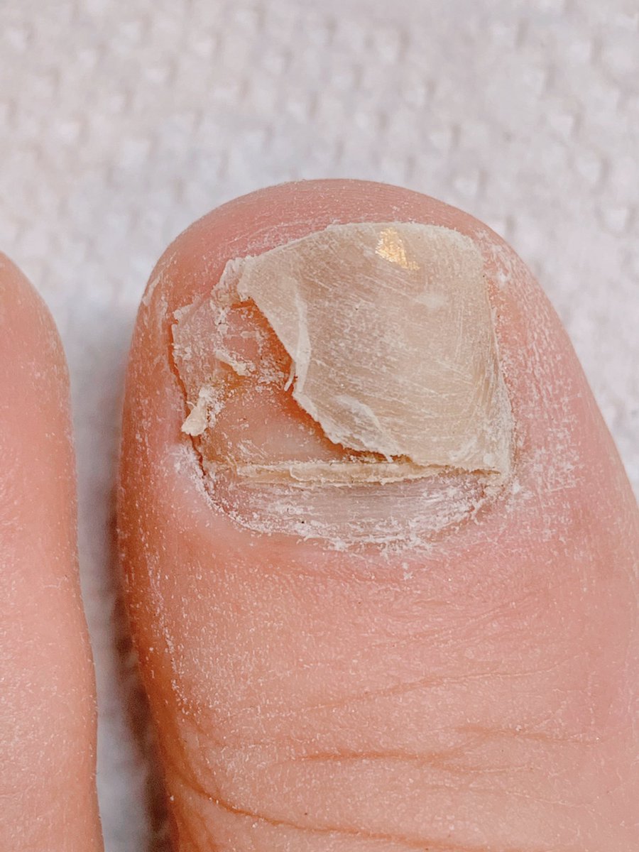 無料ダウンロード ネイル 剥がれた 爪 美しいネイルトレンド