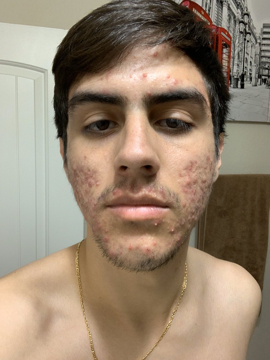 gabriiel_suarez's tweet photo. I’m not going to make this sad or sappy I’m just happy. lol This was my skin back in may this year. I was going through a lot at the time, but I’m better now. I’m glad to be comfortable in my skin now. Stay the course and you’ll be straight!! #acutane https://t.co/yD1Q99eAJr