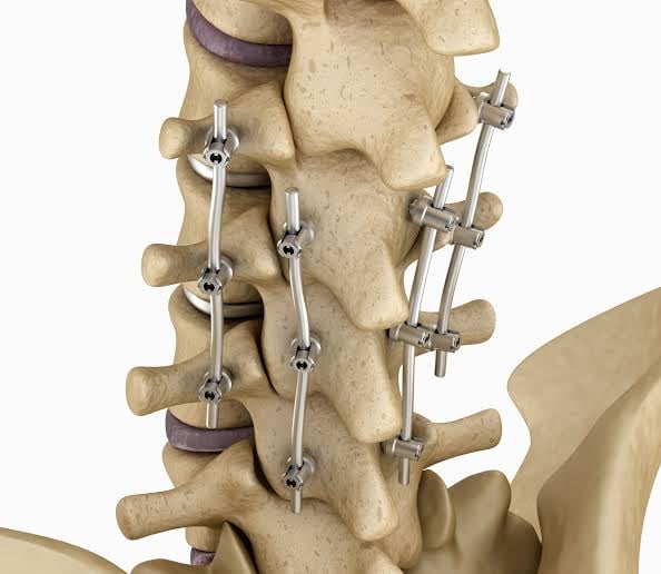 DrSusmitNaskar's tweet photo. ▶️ #MIS #spinal #fusion
▫️
▫️
This surgery is a relatively newer technique. MIS means minimally invasive surgery. The indications for surgery are same as open lumbar fusion. For Appointment : https://t.co/u0kooLZaSQ
▫️
▫️
#InvasiveSpineSurgery #SpineSurgery #Sciatica #SlippedDisc https://t.co/ybS1G6bUc0