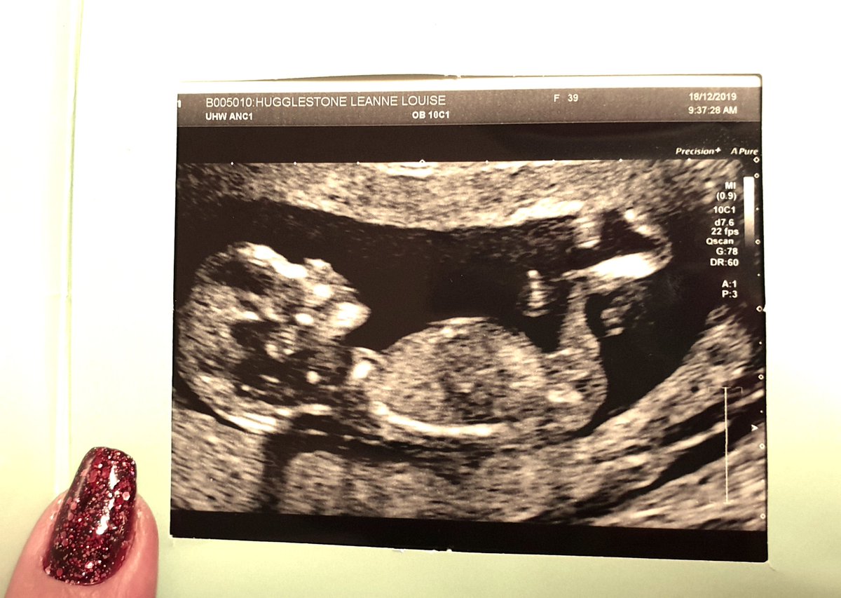 huggzy's tweet photo. So yesterday we finally got to announce the most amazing surprise and natural miracle that we are expecting june2020!!
#lifeAfterCancer #naturalMiracle #BabyMac #summerBaby
@brendonmac07 https://t.co/sn4MSz57IR