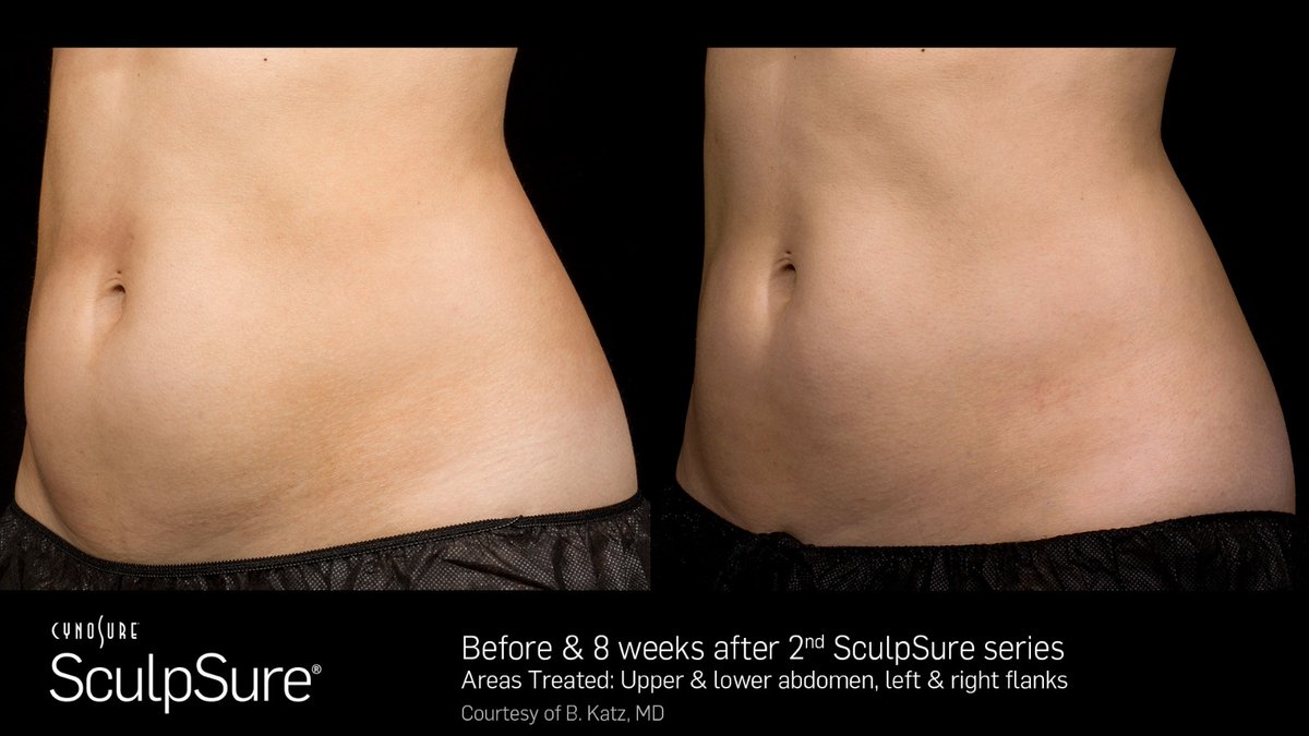 Keen to shred the weight for  #2020, why not try #sculpsure, a 
 #lasertreatment from  #cynosure. 
📝SculpSure: Bum, tum, arms, legs &amp; chin.
🎉 Results: 2-8 Wks 
⏱ Time it takes: 30 mins
☎️ 020 2914554/07464031122
💻 info@juveaaesthetics.com
🖥 juveaaesthetics.com