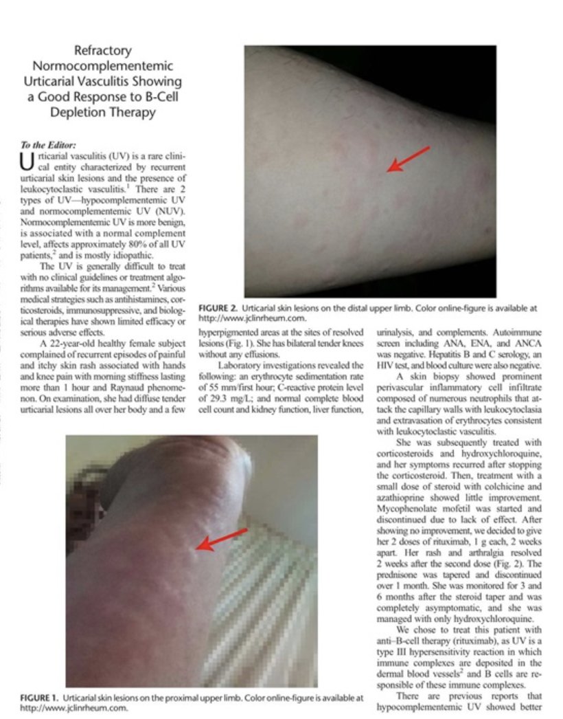 JRheumatology's tweet photo. Refractory #Normocomplementemic #Urticarial #Vasculitis with Response to #B-Cell #Depletion
https://t.co/ob4q3iNbgq https://t.co/b9kVt4PYAf