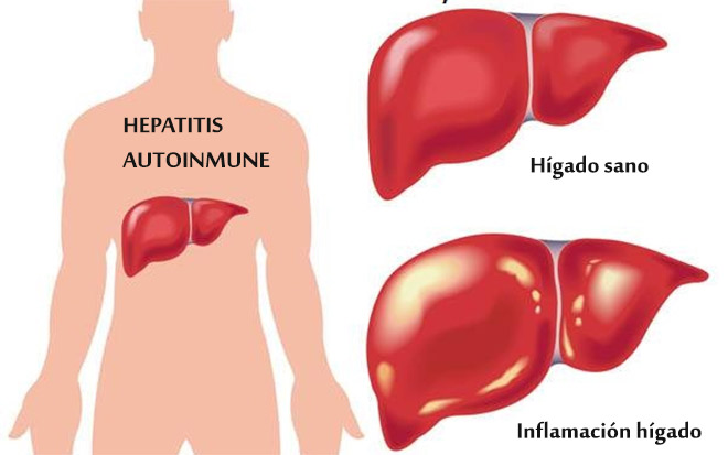 ¿Es la #HepatitisAutoinmune una enfermedad infradiagnosticada? 👉 ow.ly/rgHu50xFdCM #EnfermedadesMinoritarias #EnfermedadesRaras @CIBERehd @vallhebron @UABBarcelona