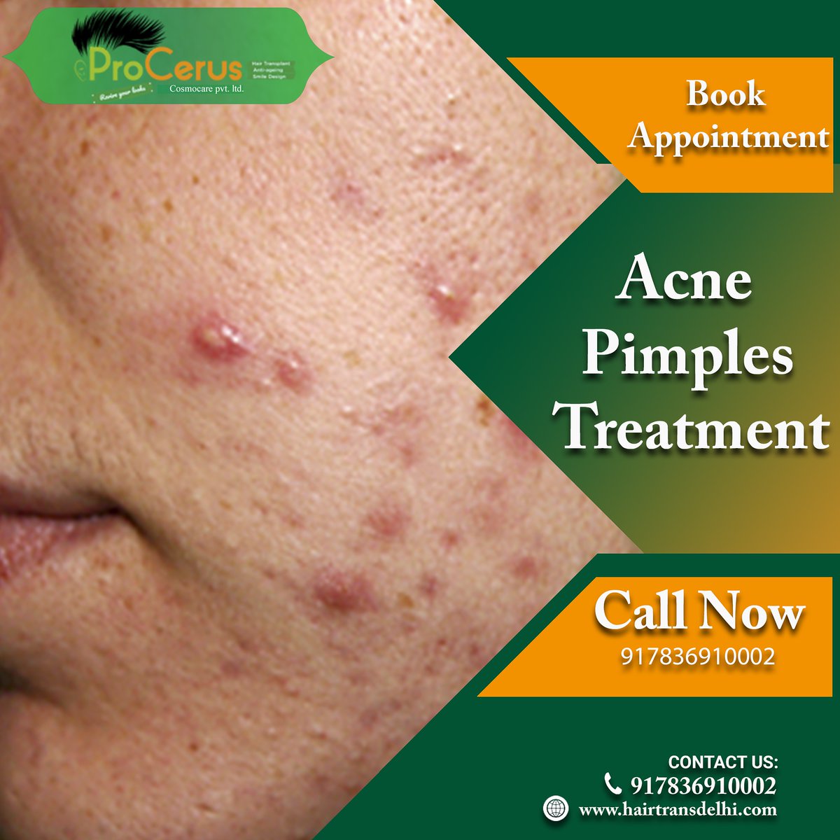 ProcerusClinic's tweet image. Have acne prone skin? 
Then you are at the right place,Get the best acne treatment at @ProcerusClinic

Appointment at Procerus Clinic 
Book +917836910002

or Enquire at lnkd.in/f32nYTN

#Acnetreatment #pimplesproblems #skincare #darkcirclesproblem #pimplesfree