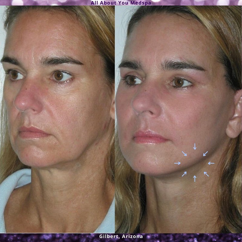 allaboutumedspa's tweet photo. #PDOThreads before and after. #nonsurgical #facelift focusing on the jowls. Our favorite treatment with no downtime! #antiaging #threads #medspa #arizona #gilbertaz #botox #cosmetic https://t.co/QywBbAzpFD