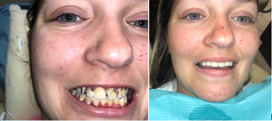 brightnowdental's tweet photo. Our @SFEFoundation is busy helping to give patients like Lyndsey and others #BigHolidaySmiles. Thanks to Dr. Jeffrey Eakin and the Pasadena, TX team for #GivingBackSmiles during the holidays! https://t.co/SI6FxGjmy4