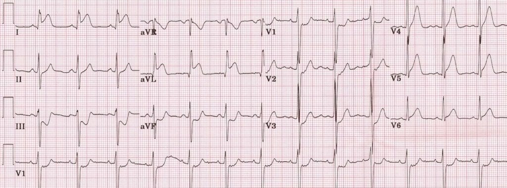 1/Ever wonder why a "STEMI" causes ST elevation on EKG?The answer is mind-bending. #medthread  #tweetorial  #medtwitter