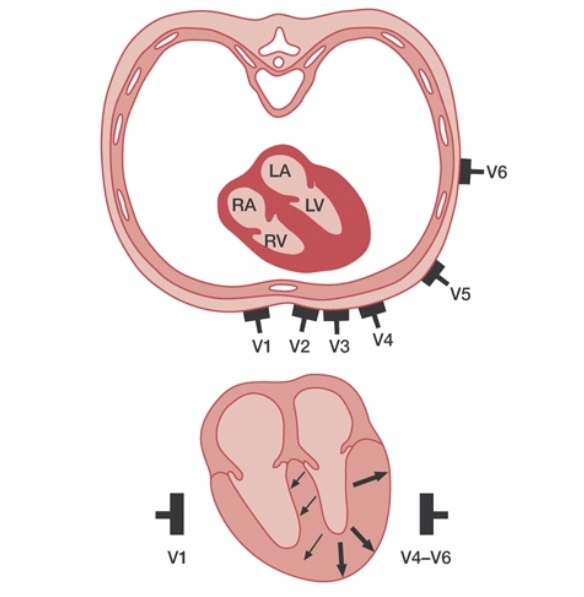 2/We need to review a few basic EKG facts.First: If electrical signals travel away from an EKG lead they appear as negative deflections If electrical signals travel toward an EKG lead they appear as positive deflections https://bit.ly/2PIRGWw 