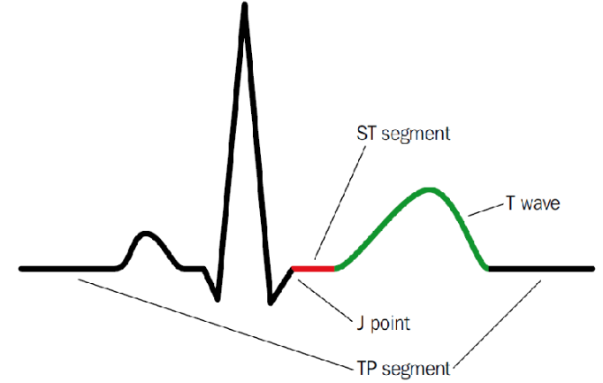 3/Second:Recall that the ST segment represents electroneutrality in the cardiac cycle, between depolarization and repolarization, w/ no voltage gradient.That's why the ST and TP baseline segments are normally flat on EKG (aka isoelectric). https://bit.ly/2PGiLJZ 
