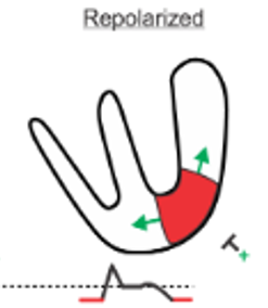 8/This difference in cycle speeds between ischemic and non-ischemic cells causes a relative current during repolarization: Ischemicnon-ischemic, away from overlying EKG leadsThis shifts the EKG baseline down, for reasons we discussed above. https://bit.ly/2s99b9l 