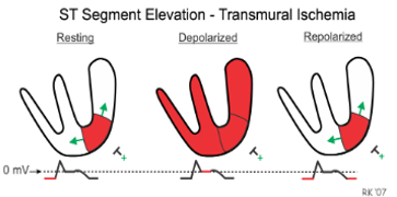 10/The ischemic ST segment therefore appears elevated on EKG, but only because the baseline has been shifted down.  https://bit.ly/2s99b9l 