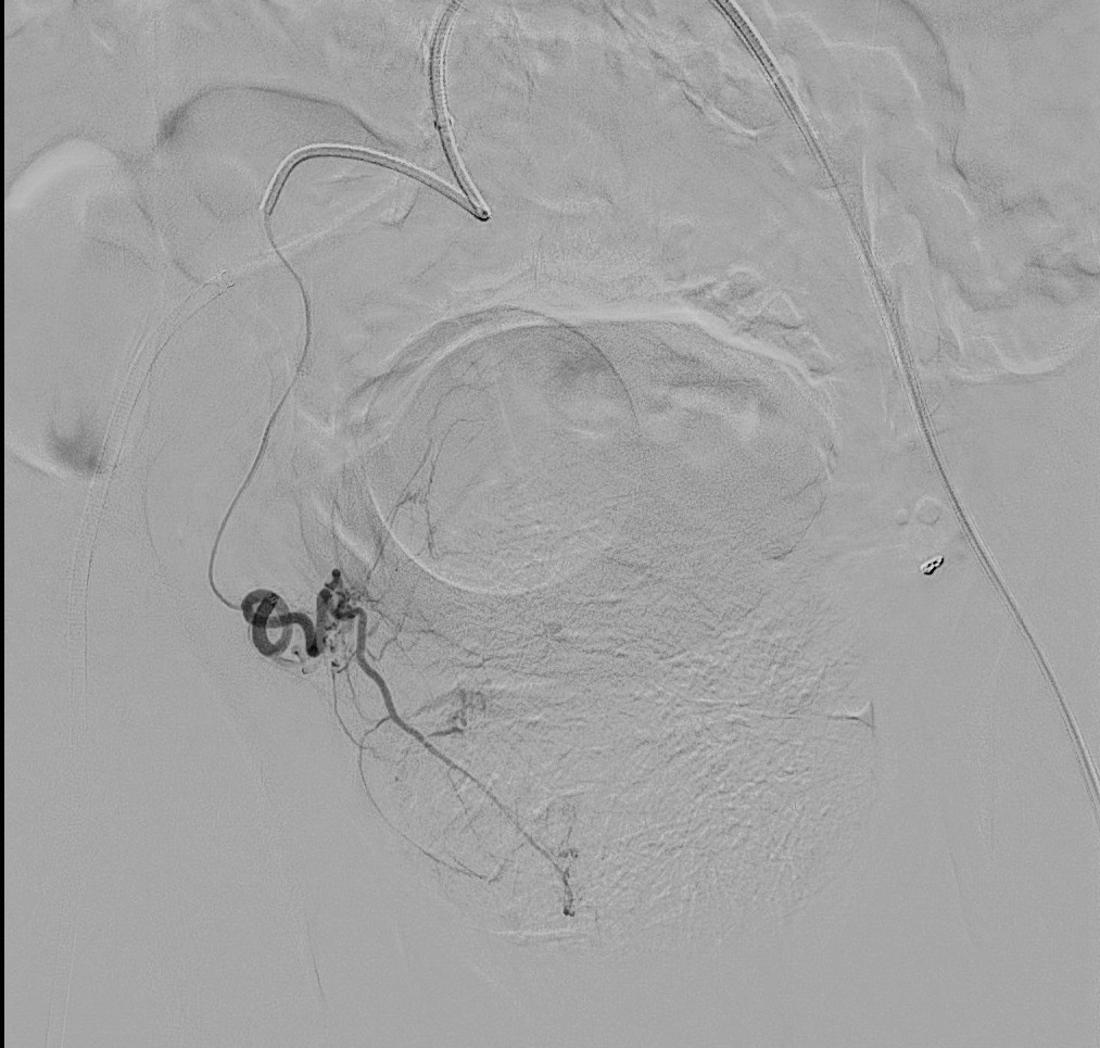 James Katrivesis, MD (@jkatrivesismd) on Twitter photo My oldest #PAE patient yet at 92 y/o. Hematuria and #LUTS. from #BPH. Transferred to #UCI after failed TURP at OSH. Bleeding stopped in 2 days and catheter out at 10 days. #IRAD <a href="/SIRRFS/">SIR RFS</a> <a href="/UCI_IR/">UCI Interventional Radiology</a> <a href="/UCIrvineHealth/">UCI Health</a> My oldest #PAE patient yet at 92 y/o. Hematuria and #LUTS. from #BPH. Transferred to #UCI after failed TURP at OSH. Bleeding stopped in 2 days and catheter out at 10 days. #IRAD <a href="/SIRRFS/">SIR RFS</a> <a href="/UCI_IR/">UCI Interventional Radiology</a> <a href="/UCIrvineHealth/">UCI Health</a>