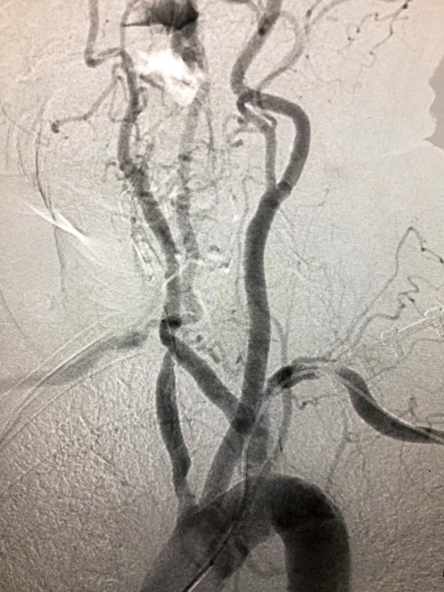 matheenkhuddus's tweet image. Interesting angiogram from today. How many notable findings do you see?  #ACCFIT #SCAIPAD