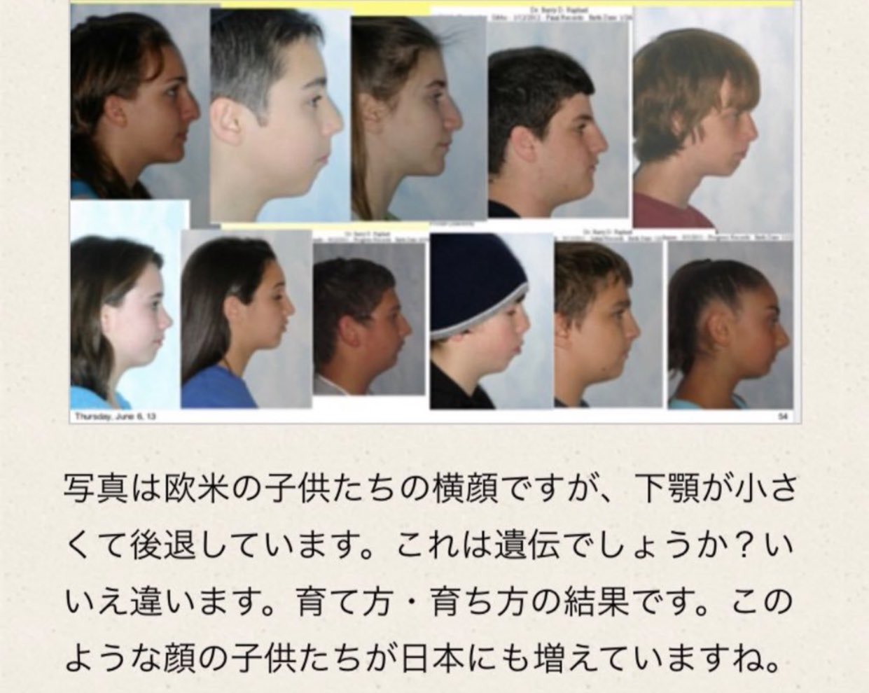 𓂃 室長さん 今の子は面長と顎なしが多いのか 顎と中顔面が垂直に成長して顔が間延びする 顎 は6歳から8歳と12歳から18歳で大きく成長する 顎を前方に育てるオーソトロピクスで立体的な顔になる T Co Johmib2dbe Twitter