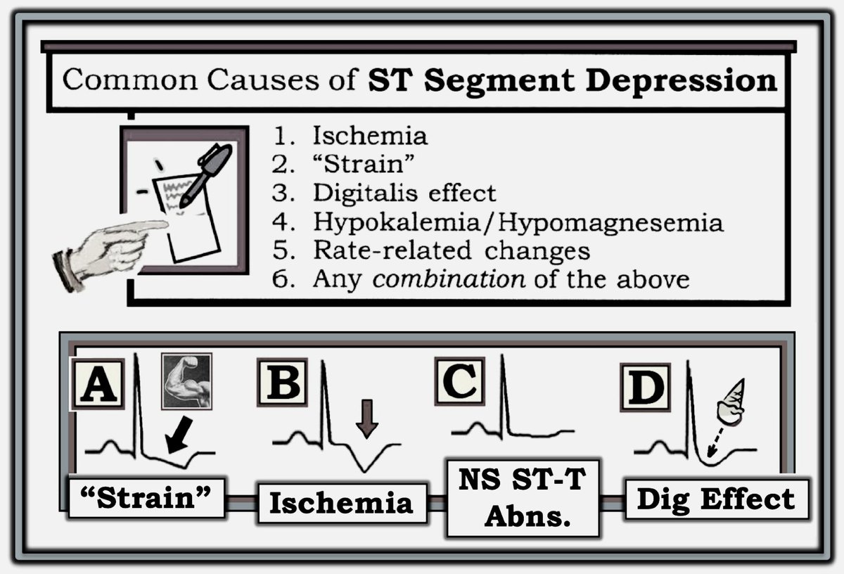 pgMedicine's tweet image. ST segment depression 

#ECG 
#digoxin 
#ischemia 
#electrolytes 
#strain 
#foamed #medEd #medtwitter #mrcp #usmle #fcps #plab #Medical #physical #exam #Physician #cardiotwitter #cardiology #clinicalpearl #mrcp #ekg #ACS #usmle