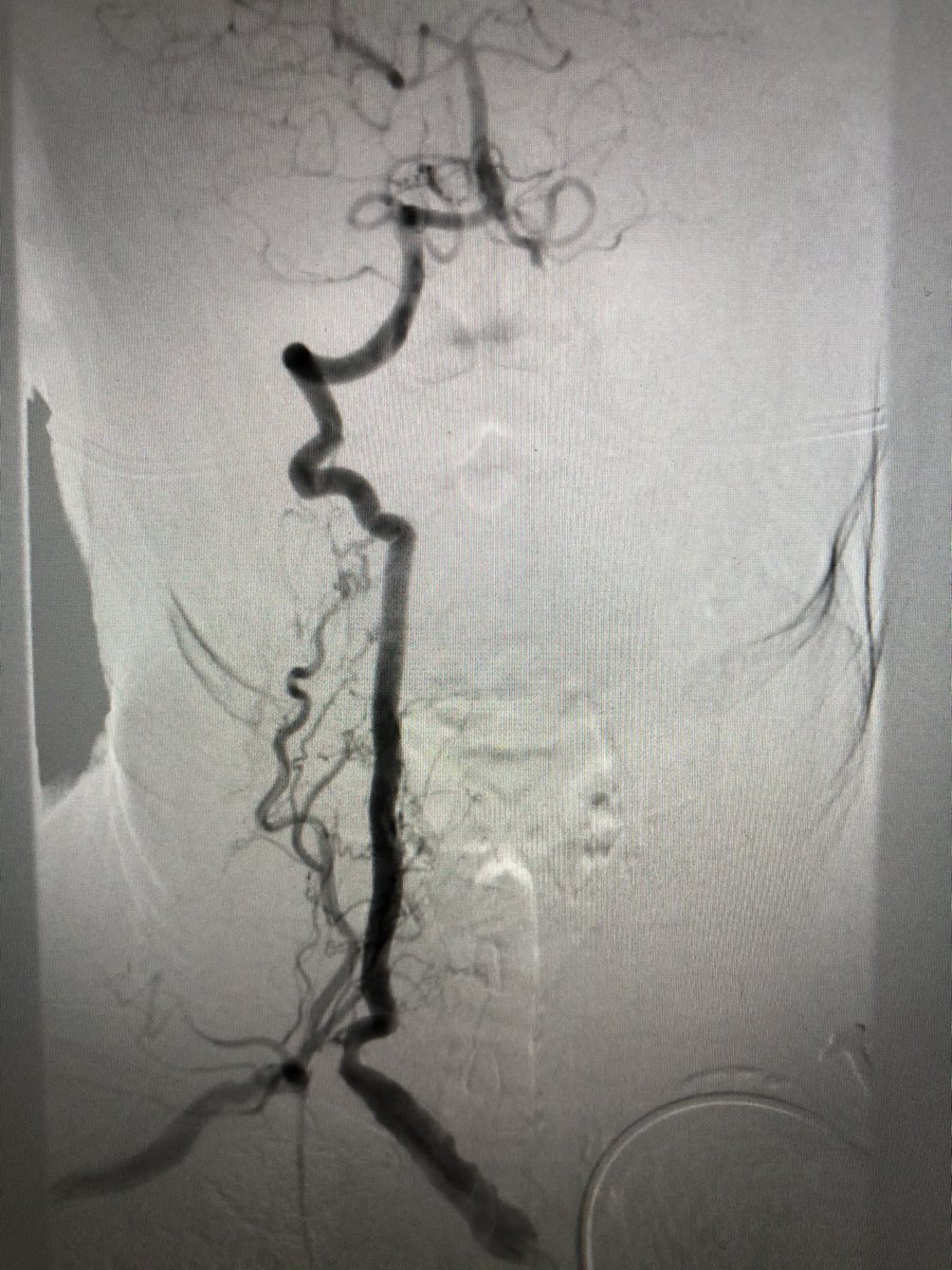 matheenkhuddus's tweet image. Hard to fully appreciate on still image. Selective angiography images  included
-R CCA stenosis and R ICA occlusion
-aberrant R SCA (Arteria Lusoria) occluded after the R vertebral origin
- moderate L SCA disease with L vertebral occlusion 

#SCAIPAD #ACCFIT #RadialFirst
