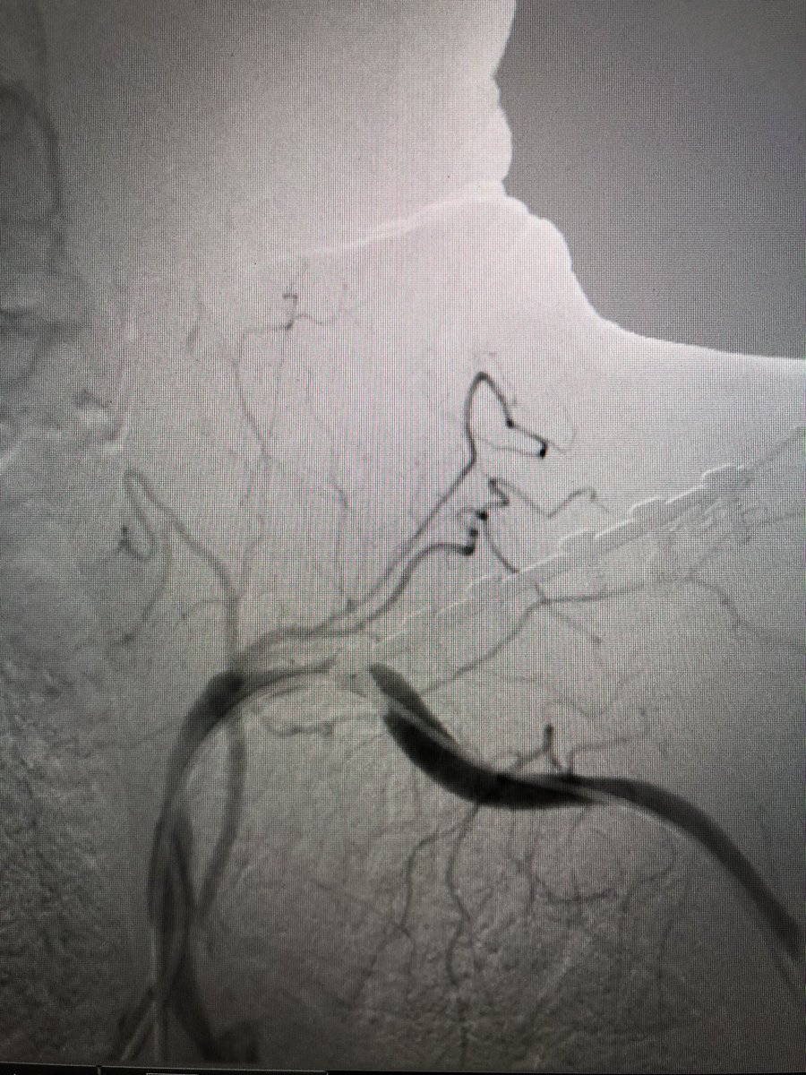 matheenkhuddus's tweet image. Hard to fully appreciate on still image. Selective angiography images  included
-R CCA stenosis and R ICA occlusion
-aberrant R SCA (Arteria Lusoria) occluded after the R vertebral origin
- moderate L SCA disease with L vertebral occlusion 

#SCAIPAD #ACCFIT #RadialFirst