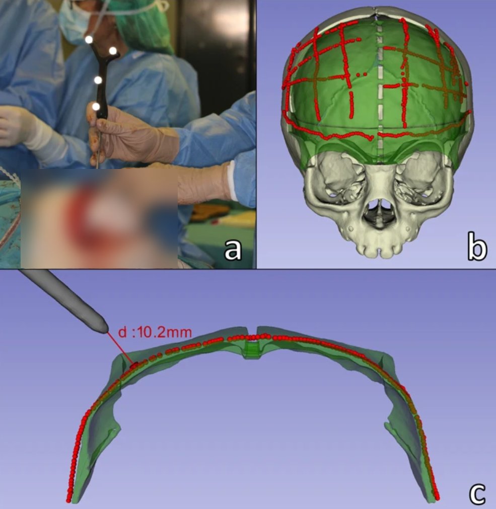 3DSlicerApp's tweet photo. 3D Slicer based segmentation, registration, and real-time surgical navigation tools improve craniosynostosis surgeries in children. See details in this Nature - Scientific Reports paper: https://t.co/ooUTgvdlE0 (open-access) https://t.co/VYt3CjaaCL