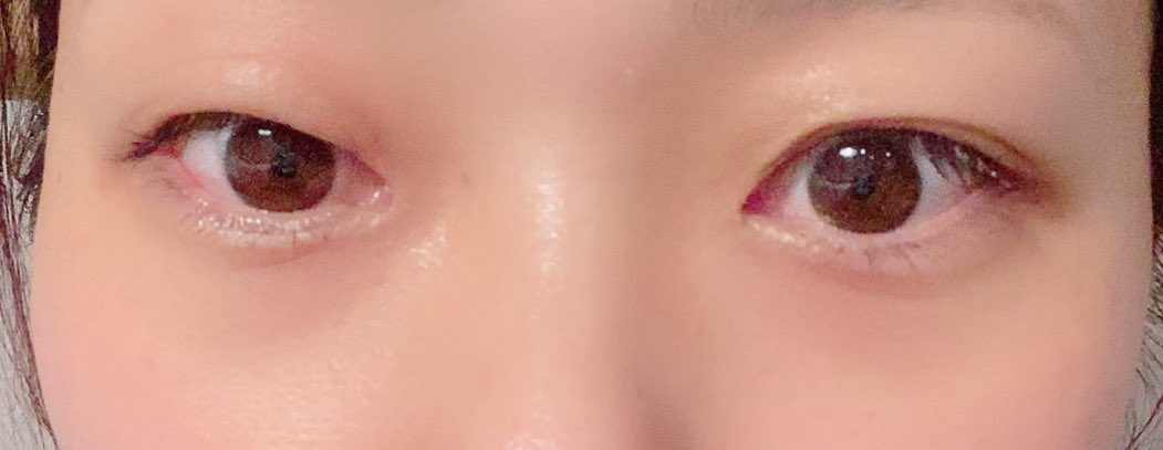 ぽにょ またお目目が腫れてきた もうこれ結膜炎じゃなくない 疲れストレスか ぽにょ またお目目が腫れてきた もうこれ結膜炎じゃなくない 疲れストレスか