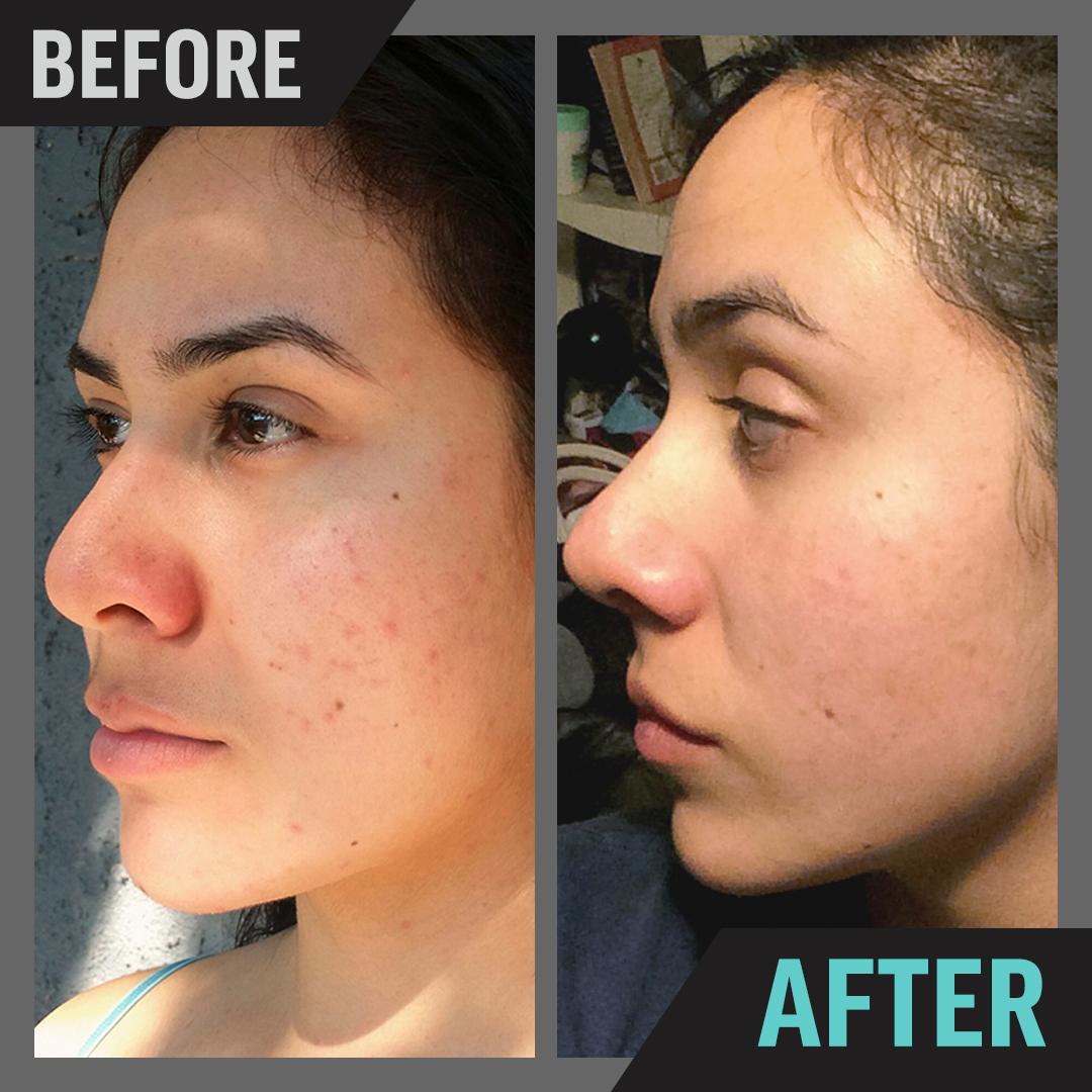XOutBreakouts's tweet photo. ✖ NO to breakouts.
✖ NO to inflammation.
✖ YES to mirror selfies.
Achieve skin results like Deanna here: https://t.co/tziynAmO1N https://t.co/FeZhUEwO5p