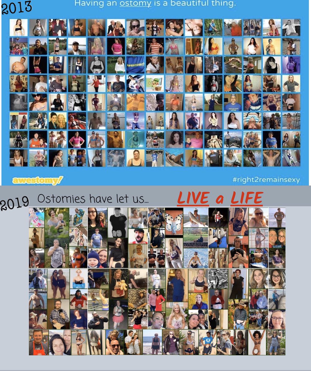 Empoweringpts9's tweet photo. A lot has changed in the 6yrs in our lives, but one thing is still the same...we’re all living a life because we had an #ostomy at some point! Life can go on and #ostomates are here to support you.
#OstomyIsNotATragedy #OstomyFamily https://t.co/kdDkjxlB6R