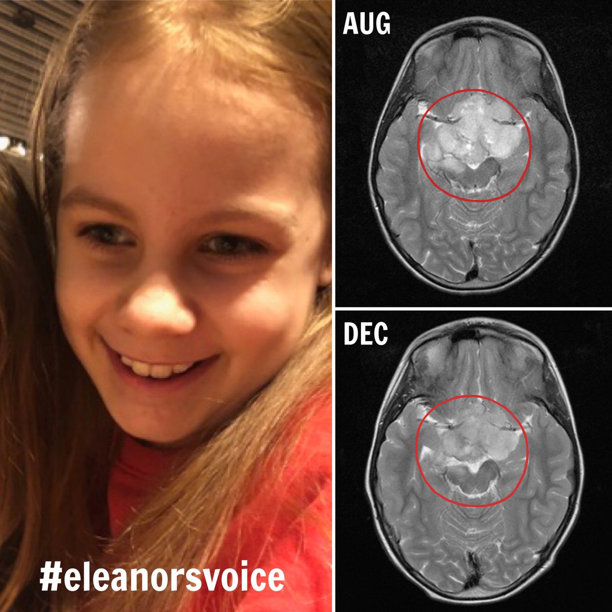 ERStollery's tweet photo. ...and finally, the results of Eleanor’s most recent #MRI show for the first time in 5 YEARS that her main tumour has shrunk &amp; is looking less enhanced. Promising news after only 3 months of the new #chemo. We are ELATED! Xmas has come early for us this year! #eleanorsvoice 💜✨ https://t.co/XNbFxbKvQE
