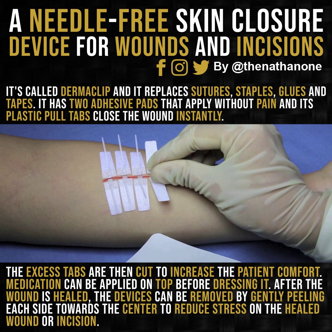 Nathanone's tweet photo. This #DermaClip device can help to close wounds without the need for stitches. #Tech #Technology #AI #ArtificialIntelligence https://t.co/eH3oJfPVbj