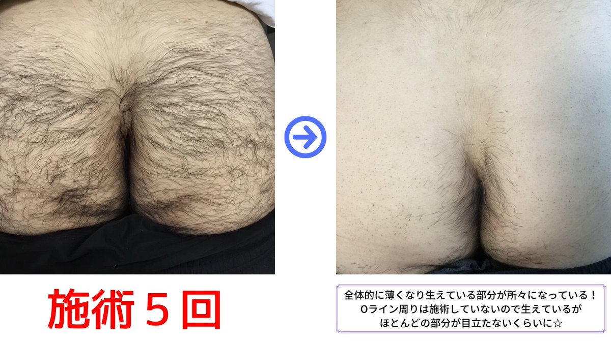 毛 処理 ケツ 男のケツ毛処理で最もおすすめの方法。脱毛レビュー有り。