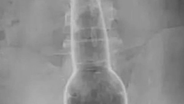 ElInformanteMX's tweet photo. Se introduce botella en el trasero porque le #picaba, se justifica ante el doctor
https://t.co/7L0mqMB83C https://t.co/nzJMnc7ip6