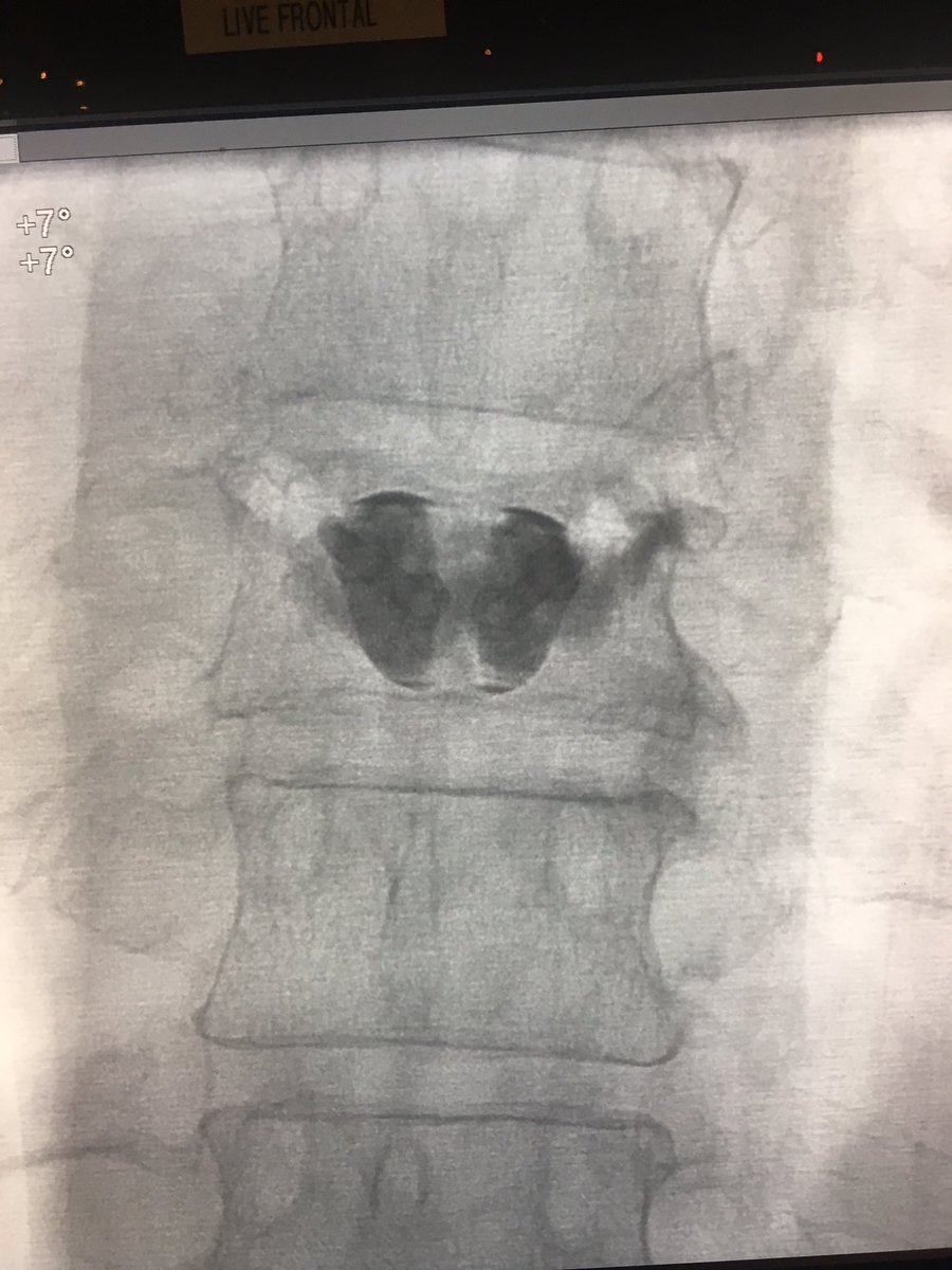 Wayne Olan (@wayneolan) on Twitter photo A little T8 #ChristmasCheer! #SpineJack 50% reduction! If you’re not jackin’ you’re not fixin’!
#ReductionAndFixation <a href="/stryker_spine/">Stryker Spine</a> #ItsBetterOn23rdStreet <a href="/dougbeall/">Douglas Beall</a> <a href="/JoshuaAHirsch/">Josh Hirsch</a> <a href="/SeanTutton/">Sean Tutton</a> A little T8 #ChristmasCheer! #SpineJack 50% reduction! If you’re not jackin’ you’re not fixin’!
#ReductionAndFixation <a href="/stryker_spine/">Stryker Spine</a> #ItsBetterOn23rdStreet <a href="/dougbeall/">Douglas Beall</a> <a href="/JoshuaAHirsch/">Josh Hirsch</a> <a href="/SeanTutton/">Sean Tutton</a>