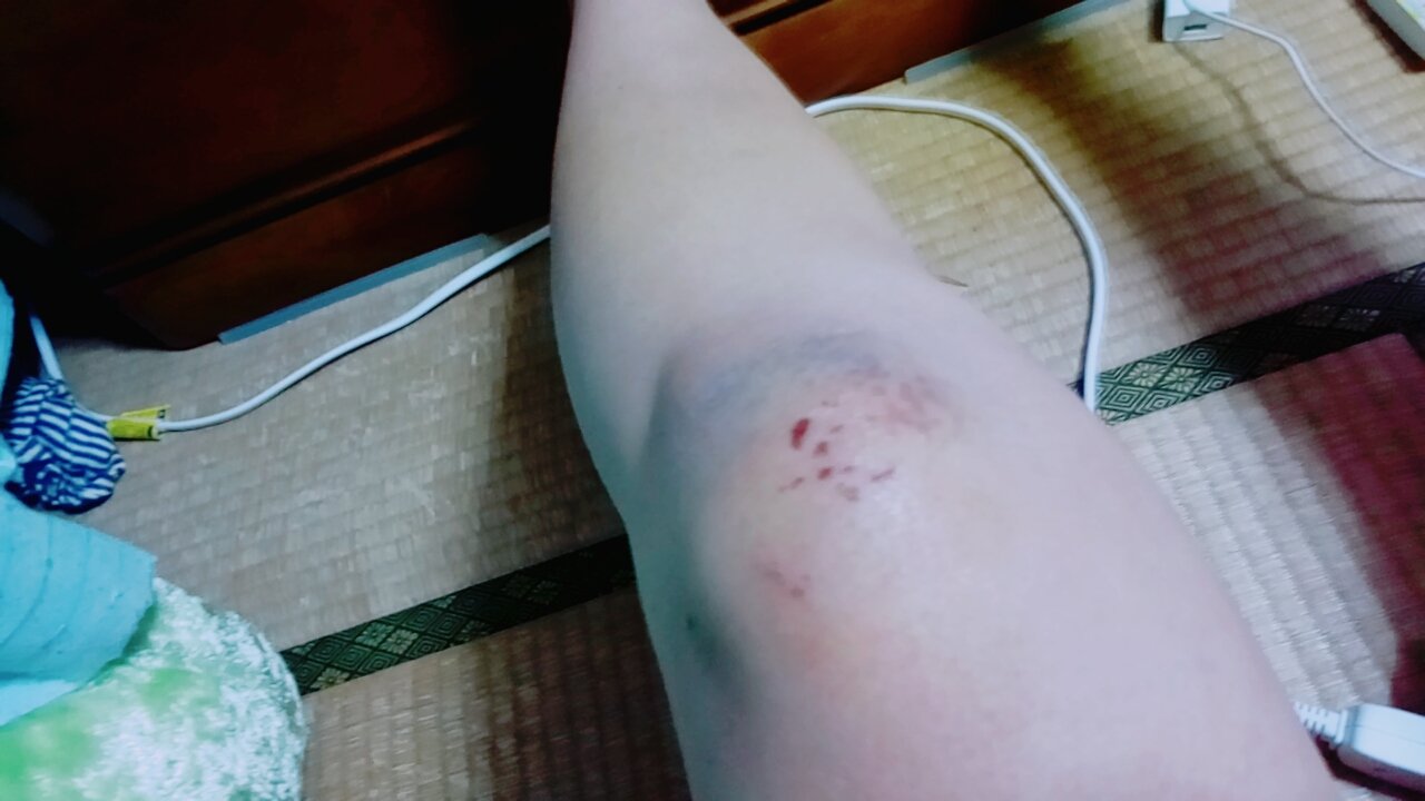 まほ バイクで怪我してめっちゃ痛みが治まらない 腫れは怪我 した日よりは治まってる感じするけど青たんの大きさが広すぎて膝たちもできないし寝返りしただけでも少し痛む この怪我はいつ治るんだろう 一枚目 怪我した日 二枚目 昨日 三枚目