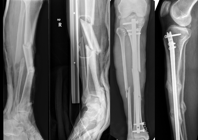 TraumaHottopics's tweet photo. Fracturas complejas de tibia: técnicas de reducción y fijación :poller, placas ,abordaje suprapatelar en @hottopicstrauma , mesa de tibia. Consulta programa en https://t.co/3kf4swH3hI https://t.co/eUNI0V0Ek1