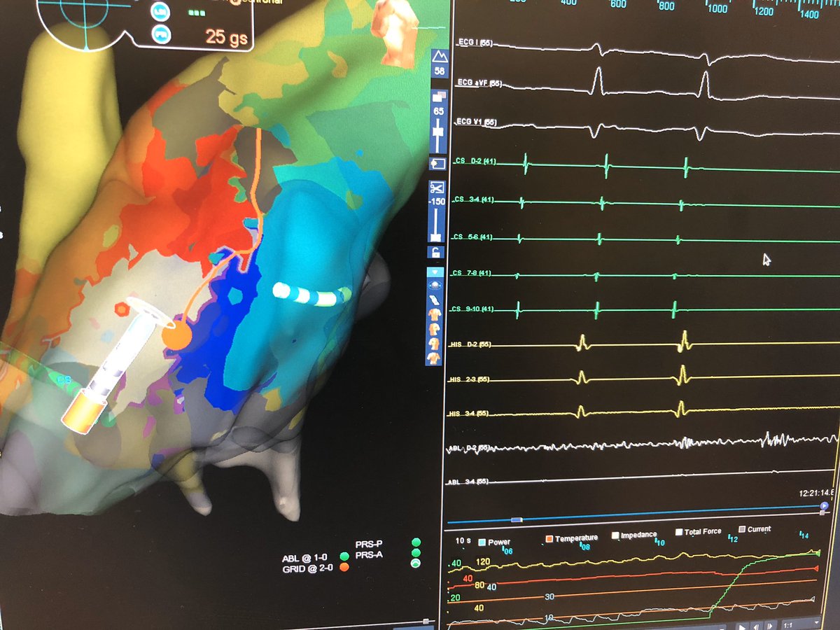 Great job Dr. Alexander! RA incisional flutter mapped with #HDGrid terminated with #Tacticath 3 min of mapping, 7k points and <1 sec terminated.