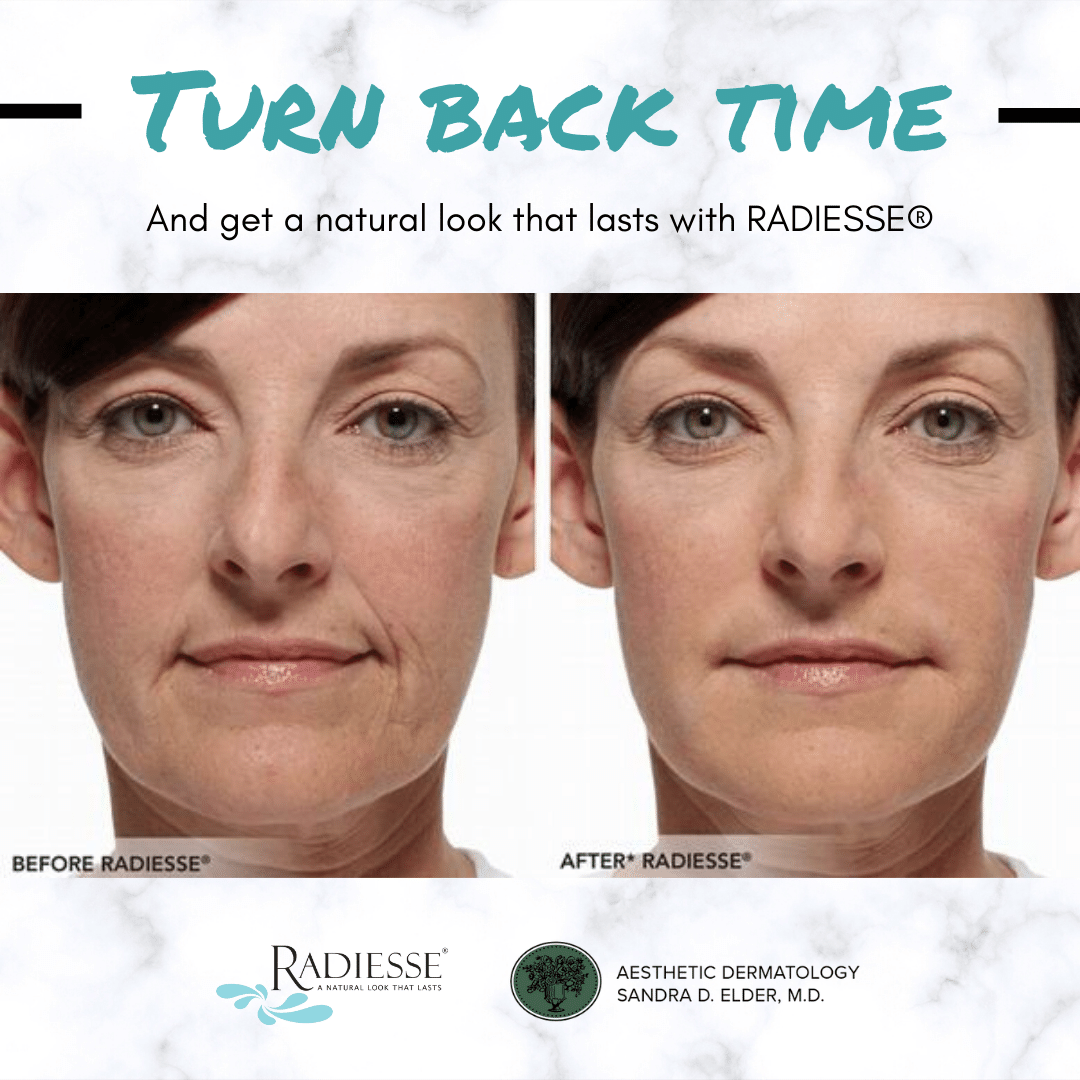 AestheticDerma's tweet photo. Have you tried #radiesse  yet? Book a consultation today! 🌞
-
-
-

#Natural #Fillers #NJMedSpa #Beauty https://t.co/eyJvHqJ3gl