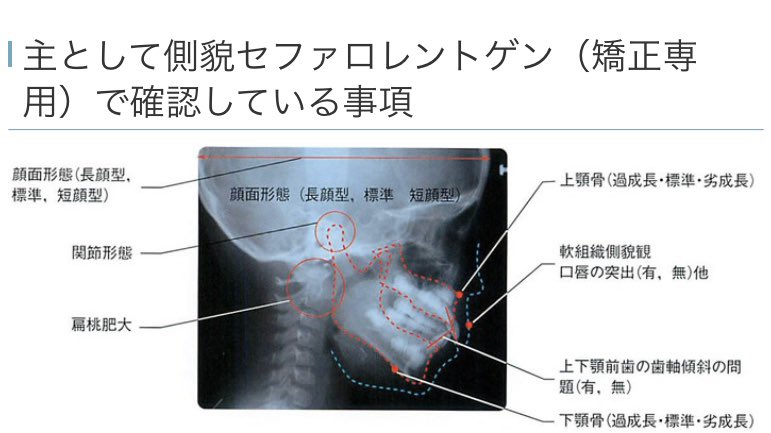 矯正や手術考えているならセファロ分析が大事。顔面形態、上顎骨の状態、下顎骨の状態、口唇の突出の有無、歯軸傾斜の問題、顔貌の対称性、歯列の幅、咬合平面の傾斜の有無、下顎の偏位など、知ること沢山。自分の顔の特徴をちゃんと把握せずに医者に丸投げしたことが今でも心残り https://t.co/Md1jmNwnwQ