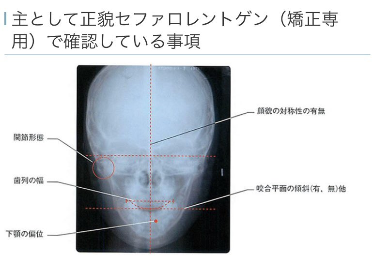 矯正や手術考えているならセファロ分析が大事。顔面形態、上顎骨の状態、下顎骨の状態、口唇の突出の有無、歯軸傾斜の問題、顔貌の対称性、歯列の幅、咬合平面の傾斜の有無、下顎の偏位など、知ること沢山。自分の顔の特徴をちゃんと把握せずに医者に丸投げしたことが今でも心残り https://t.co/Md1jmNwnwQ
