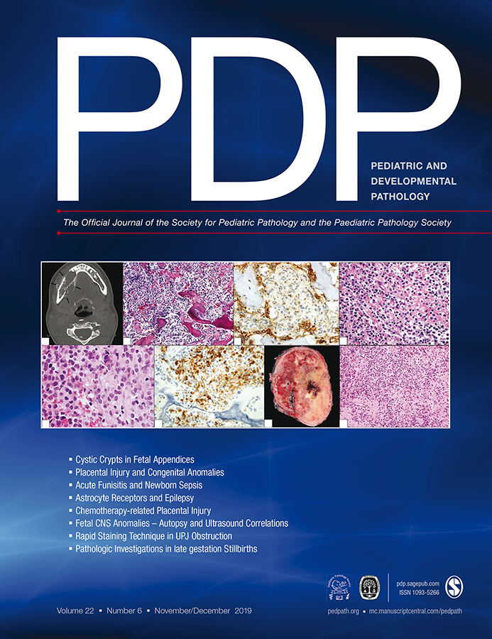 Archana Shenoy (@ashenoy_md) on Twitter photo First it was the CAP abstract book and now this! It has been a good year for cover photos. <a href="/PediDevPath/">PediDevPath</a> Thank you for the selection! Article on Sclerosing Epithelioid Fibrosarcoma of Bone with EWSR1-CREB3L3 fusion here: journals.sagepub.com/doi/full/10.11… #pedipath <a href="/SocPediPath/">Soc. Pediatric Path.</a> <a href="/LeaSurrey/">Lea F. Surrey</a> First it was the CAP abstract book and now this! It has been a good year for cover photos. <a href="/PediDevPath/">PediDevPath</a> Thank you for the selection! Article on Sclerosing Epithelioid Fibrosarcoma of Bone with EWSR1-CREB3L3 fusion here: journals.sagepub.com/doi/full/10.11… #pedipath <a href="/SocPediPath/">Soc. Pediatric Path.</a> <a href="/LeaSurrey/">Lea F. Surrey</a>