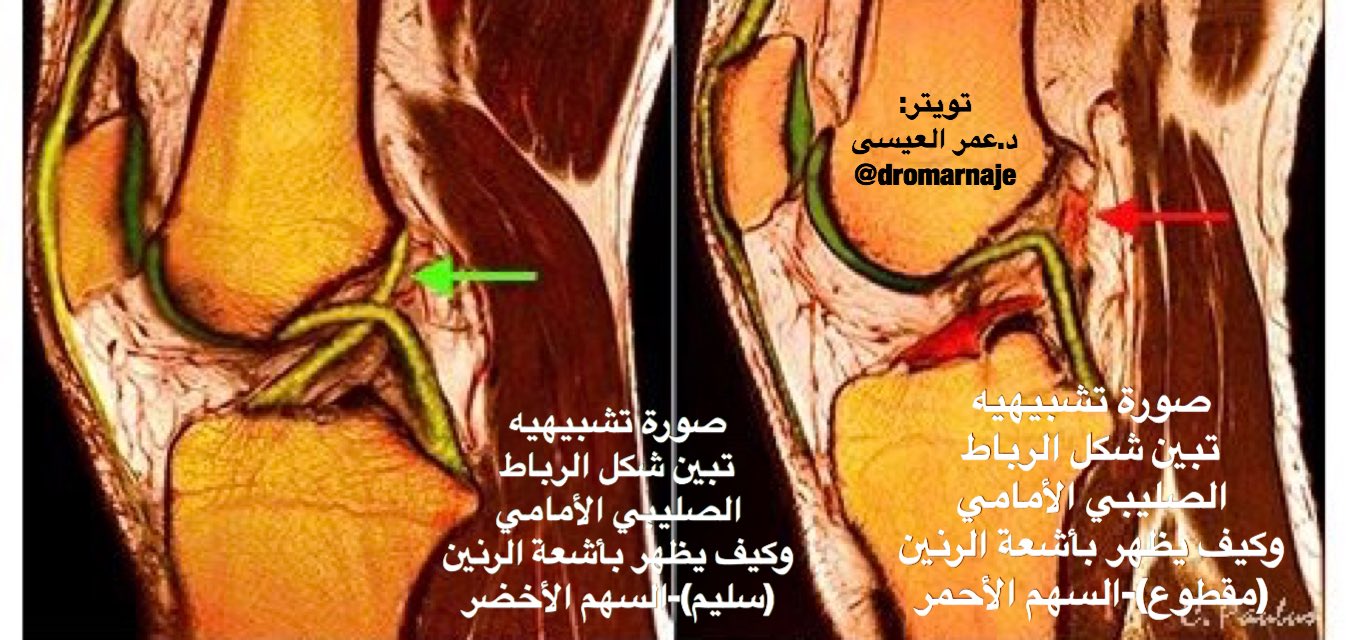 Мрт коленного сустава. Томограф для суставов. Скт тазобедренного сустава. Повреждение крестообразной связки коленного сустава мрт. Коксартроз тазобедренного сустава мрт.